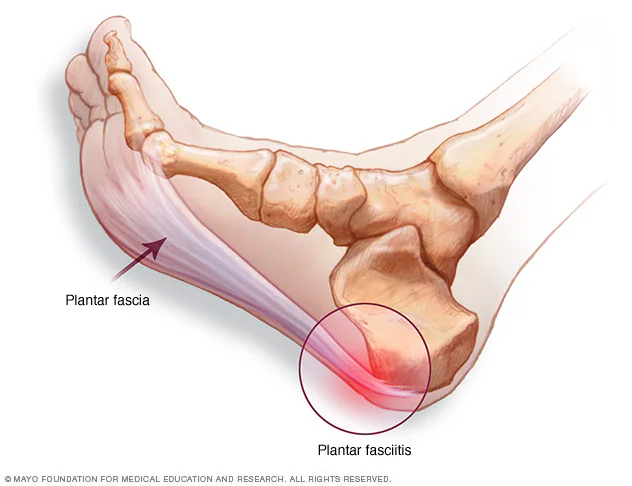 Illustration of the heel bones showing plantar fascia