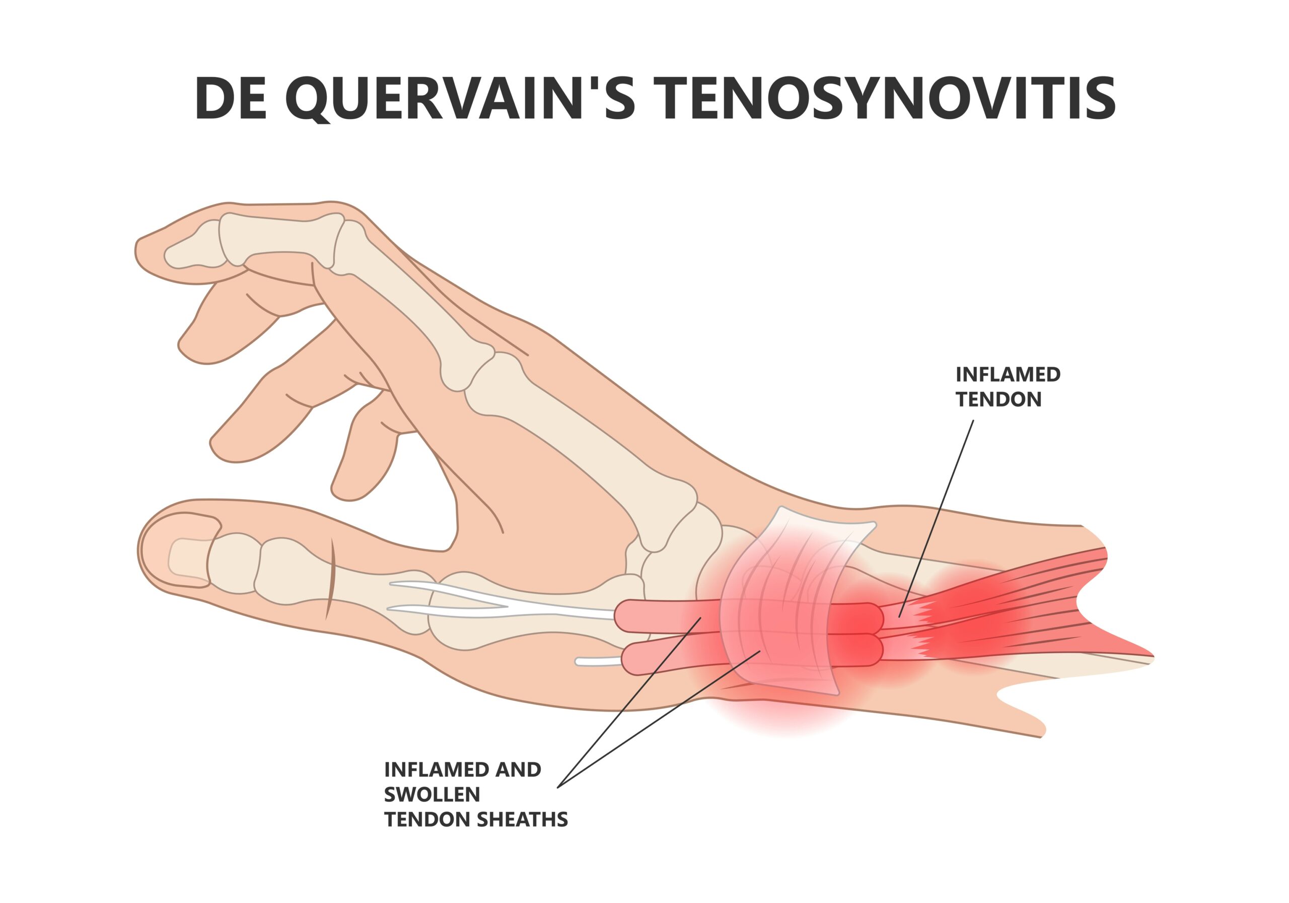 anatomical illustration of the hand and wrist showing areas affected by De Quervain tenosynovitis